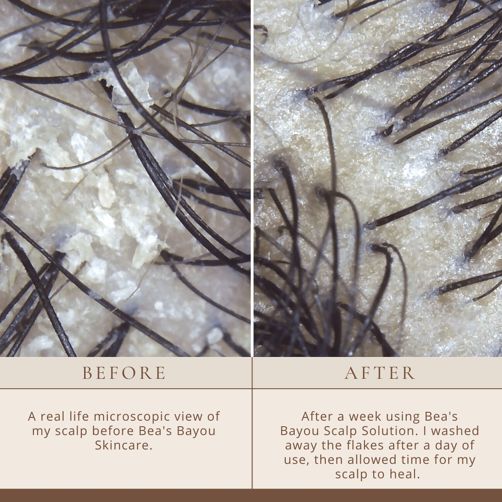 YeastDefense®️ Seborrheic Scalp Solution | Herbal Leave-in