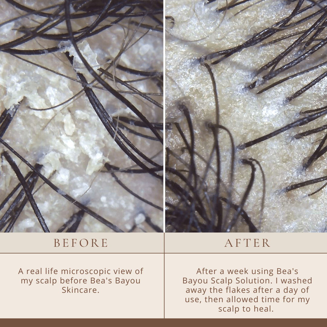 YeastDefense®️ Seborrheic Scalp Solution | Herbal Leave-in