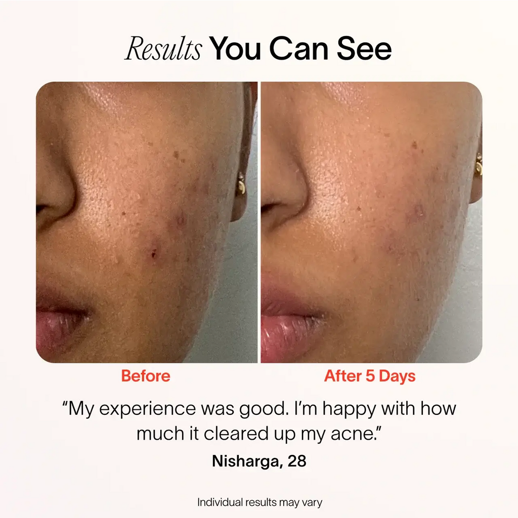 Bye Acne: 3-Minute Pimple Spot Treatment